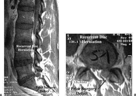 Revision Disc Surgery: Technical Challenges | Neupsy Key