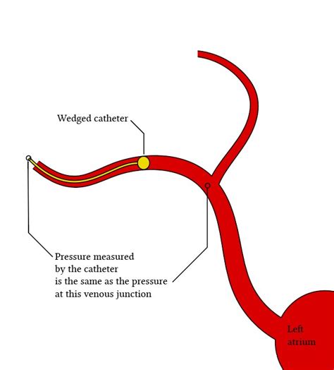 Physiology of pulmonary artery wedge pressure measurement | Deranged Physiology