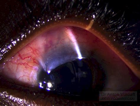 Juvenile Open Angle Glaucoma – Tropical Ophthalmology