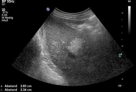 Liver Lesions Ultrasound