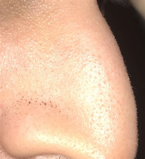 [Skin concerns] These black spots on my nose never go away. Please tell me how to get rid of ...