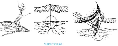 MBBS Medicine (Humanity First): SUTURE MATERIALS AND SUTURING TECHNIQUE