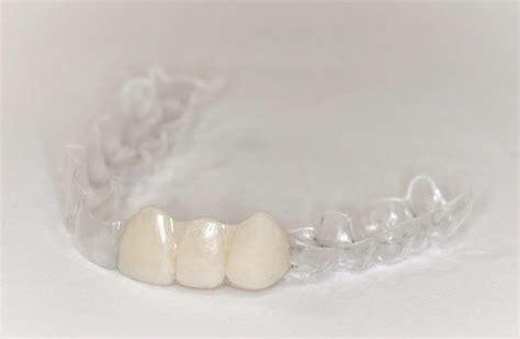 Essix Retainers – Dentists in Surrey | Vivant Dental