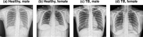 Chest X Ray Tb Vs Normal