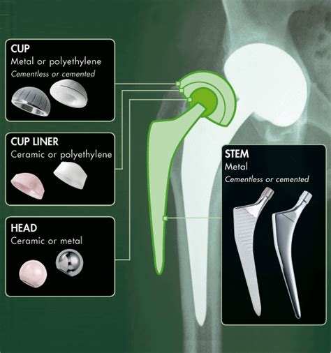 Hip Implant Information - Hobart Orthopaedics