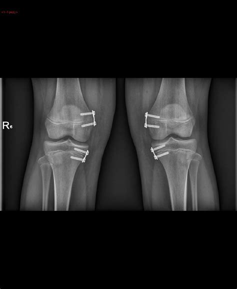 Figure 1 from Correction of genu valgum by 8-plate technique: correlation of mechanical axis ...