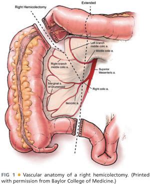 Right Hemicolectomy: Open Technique | Abdominal Key