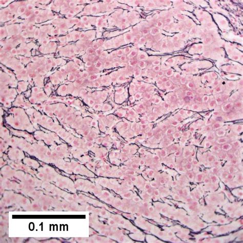 Focal nodular hyperplasia - Libre Pathology