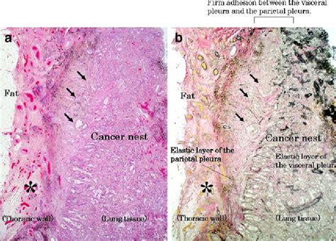 Classification of parietal pleural invasion at adhesion sites with surgical specimens of lung ...