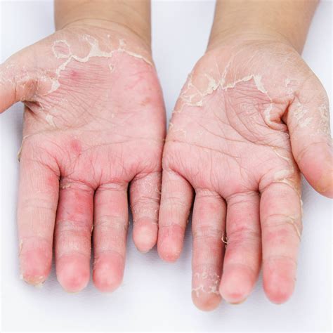 IrritantContactDermatitis - Dermatitis Academy