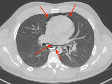 Cureus | A Case of Spontaneous Pneumomediastinum Following Ecstasy and Marijuana Use