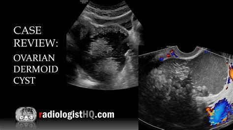 Case Review: Ultrasound of Ovarian Dermoid Cyst - YouTube