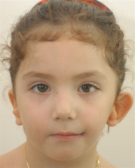 Goldenhar Syndrome | Hellenic Craniofacial Center