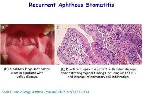 Recurrent aphthous stomatitis