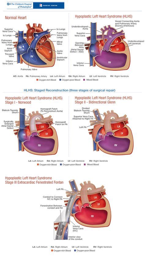 10 Best Norwood Procedure ideas | heart surgery, norwood procedure, norwood