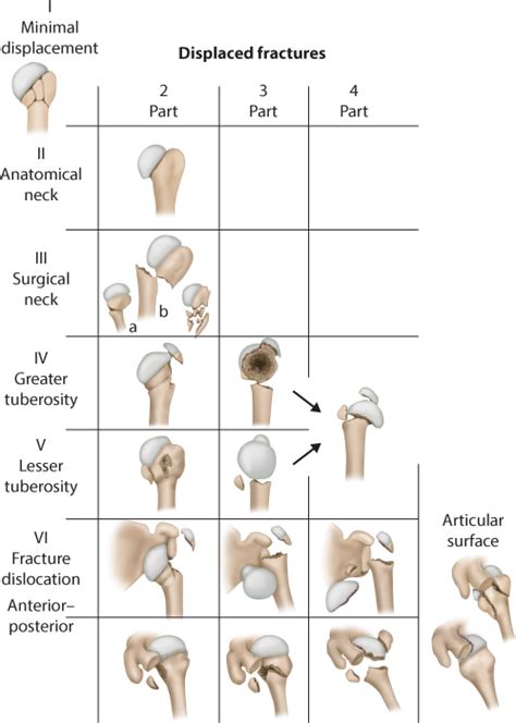 أ. د حسان النعمانى - Proximal humeral fractures