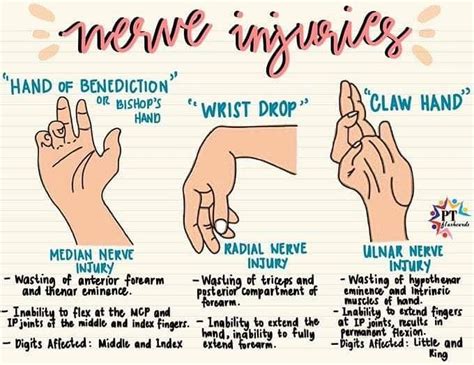 Hand deformities of nerve injury - MEDizzy