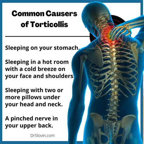 What is Wry Neck, and How’s it Treated? - Dr. Slovin