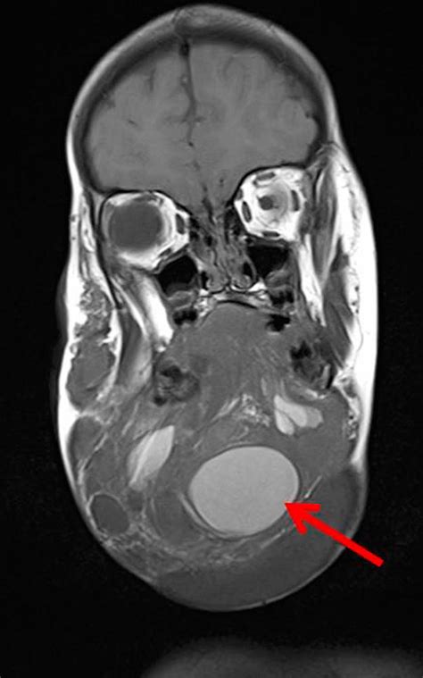 Compva: Complications in the natural course — Lymphatic malformation