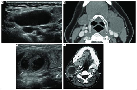 Second branchial cleft cyst. A: ultrasound, and B: contrast-enhanced CT ...