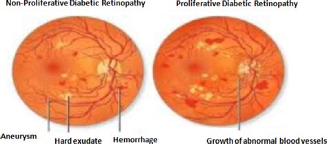 Moderate Nonproliferative Diabetic Retinopathy