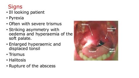 Tonsillitis, quinsy and adenoiditis