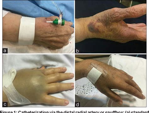 Figure 1 from Nursing assessment of vascular complications after ...