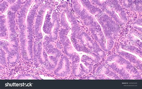 Histology Endometrial Biopsy Showing Complex Hyperplasia Stock Photo ...