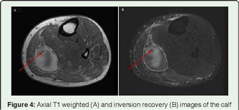 Figure 5 from MRI Evaluation of Calf Hematoma: Frequency of Plantaris ...