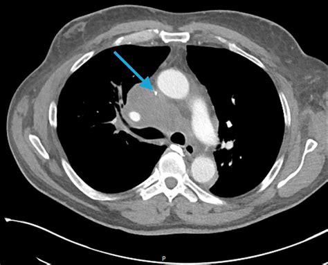 A Rare Case of Syndrome of Inappropriate Anti-diuretic Hormone in Non-small Cell Lung Cancer ...