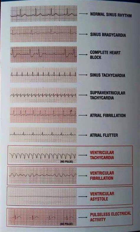 Reading EKG Strip Cheat Sheet