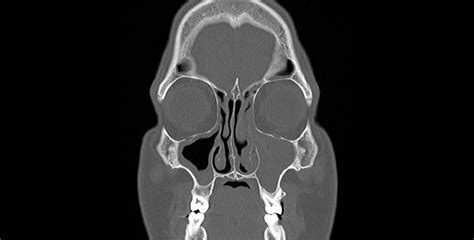 Chronic sinusitis – imaging your sinuses - Dr Jeeve ENT Specialist