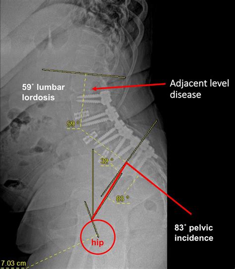 Jane's story | Lordosis & Pelvic incidence | Mayfield Brain & Spine