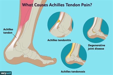 Achilles Tendon Pain: Causes, Treatment, and When to See a Healthcare ...