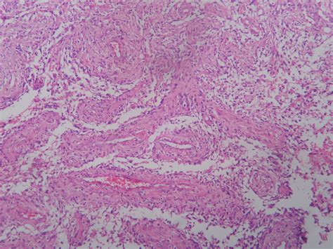 GLIOSARCOMA (ATLAS) – Histopathology.guru