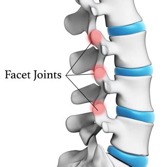 Facet Joint Injections | Interventional Pain Management Center