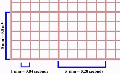 The 6 Steps Method On How To Interpret Electrocardiogram Results EASILY ...