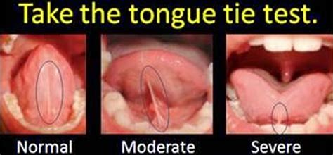 Cat Got Your Tongue? The Problems of Being Tongue and Lip Tied - Queen ...