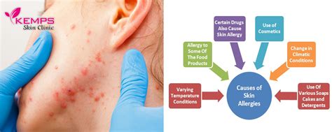 What is the root cause of skin allergies? | KEMPS Skin Clinic