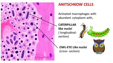 ACUTE RHEUMATIC FEVER - Pathology Made Simple