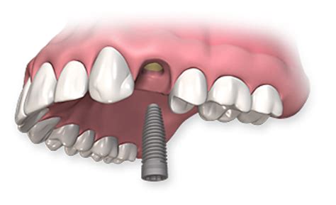 Single Tooth Dental Implants