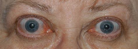 Thyroid Eye Disease