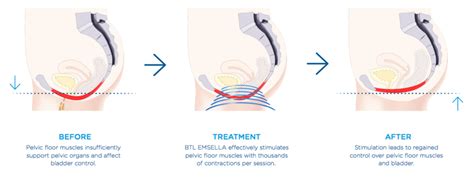 Emsella - A Breakthrough Treatment for Incontinence | Catherine Vanderloos, MD in Louisiana