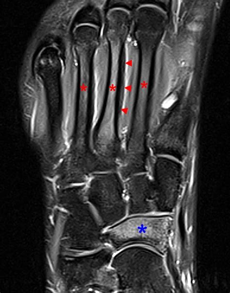 Stress fractures in the foot and ankle