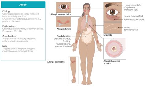 Drug Hypersensitivity Syndrome