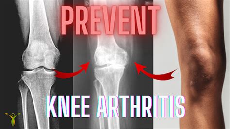 Exercises for Knee Osteo-arthritis | Knee OA And Joint Pain