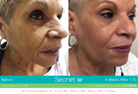 Secret RF Microneedling Treatment | SpaMD | Wichita KS