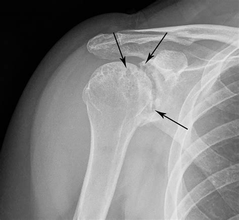 Cureus | Rice Body Formation Within a Peri-Articular Shoulder Mass