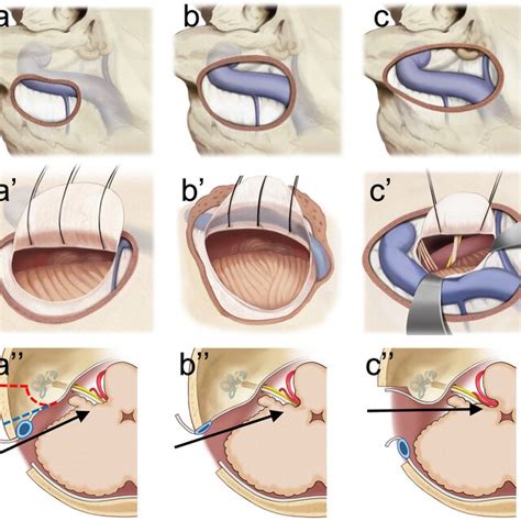 Participant flow diagram. MVD, microvascular decompression; HFS,... | Download Scientific Diagram