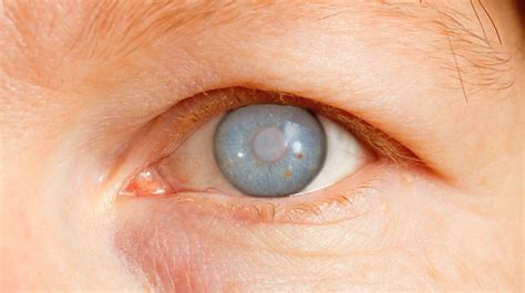 Glaucoma: 10 claves para prevenir esta enfermedad ocular | La Opinión